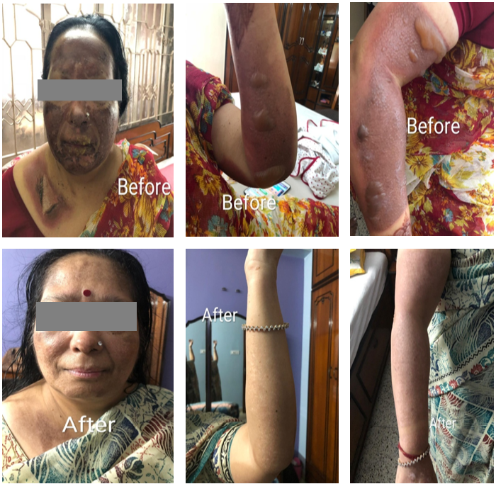 Healing Of Severe Burns Through Sujok Therapy : A Case Report
