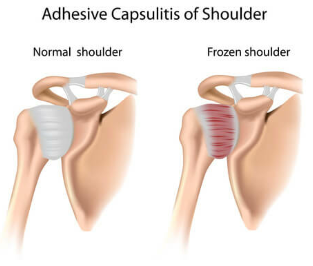 A case of frozen shoulder and hand numbness–Cured by Sujok Therapy