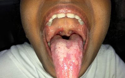 Efficacy of Sujok Therapy in enlarged adenoids and tonsils