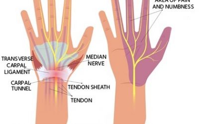 Sujok Therapy in Carpal Tunnel Syndrome