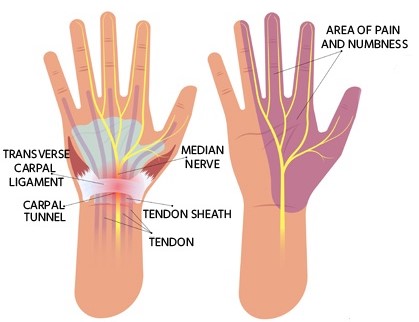 carpa-tunnel-syndrome (2)